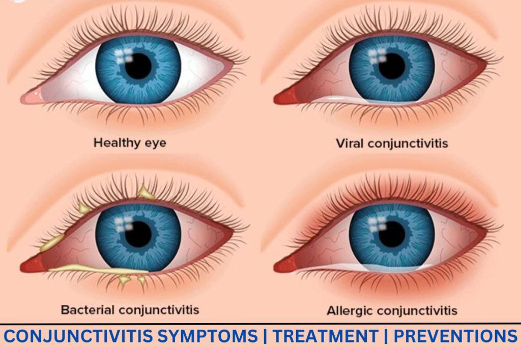 Causes of Flu in Eyes