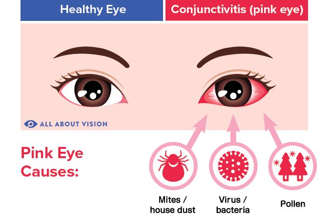 eye flu Symptoms