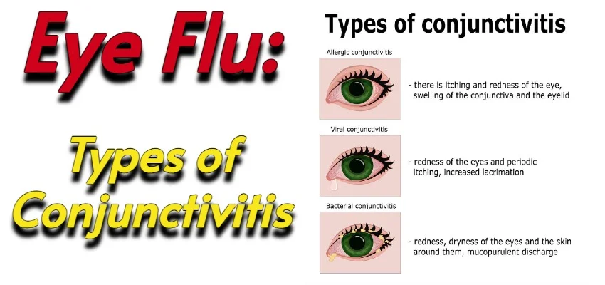 eye flu treatment
